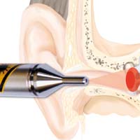 Multifunktionelle Therapiespitze